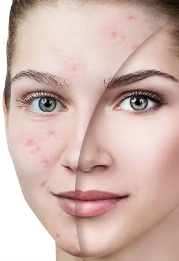 Acne Treatment Durban North